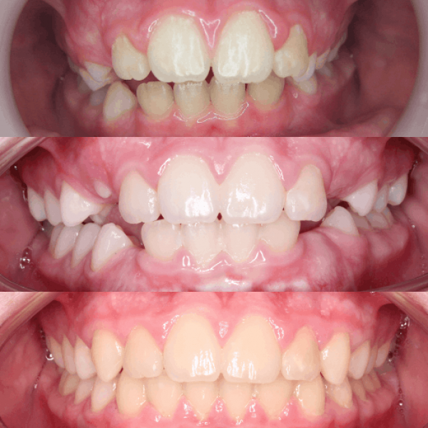 Evolution de la denture après traitement orthodontique